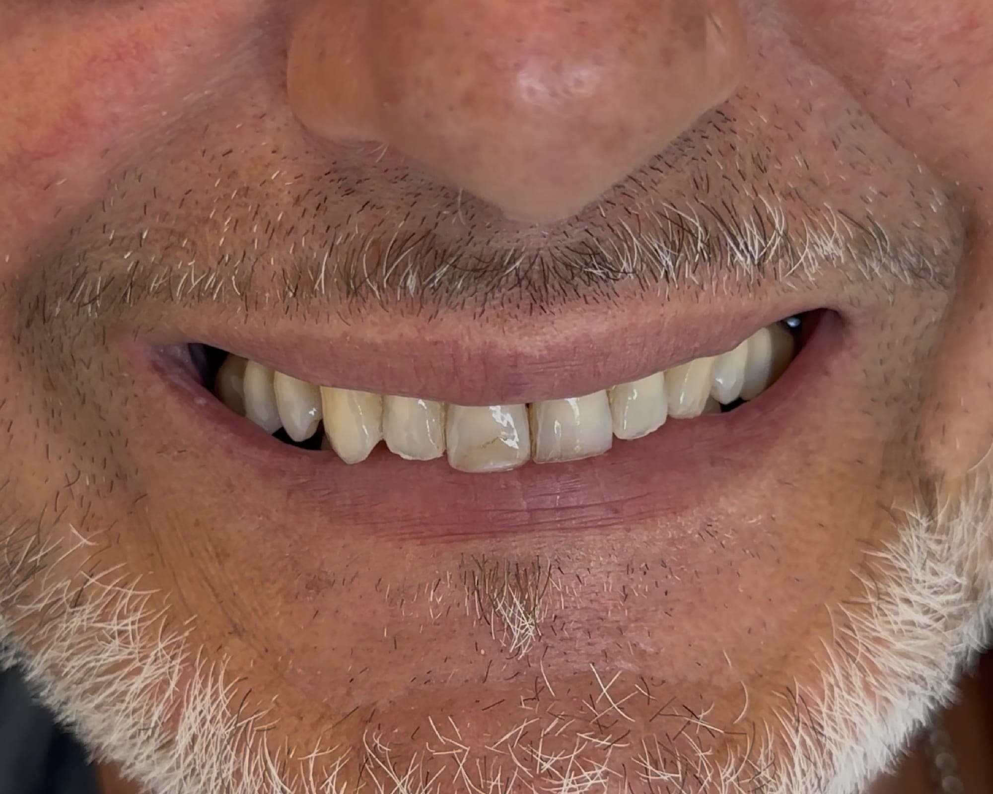 Sourire de Marco, avant