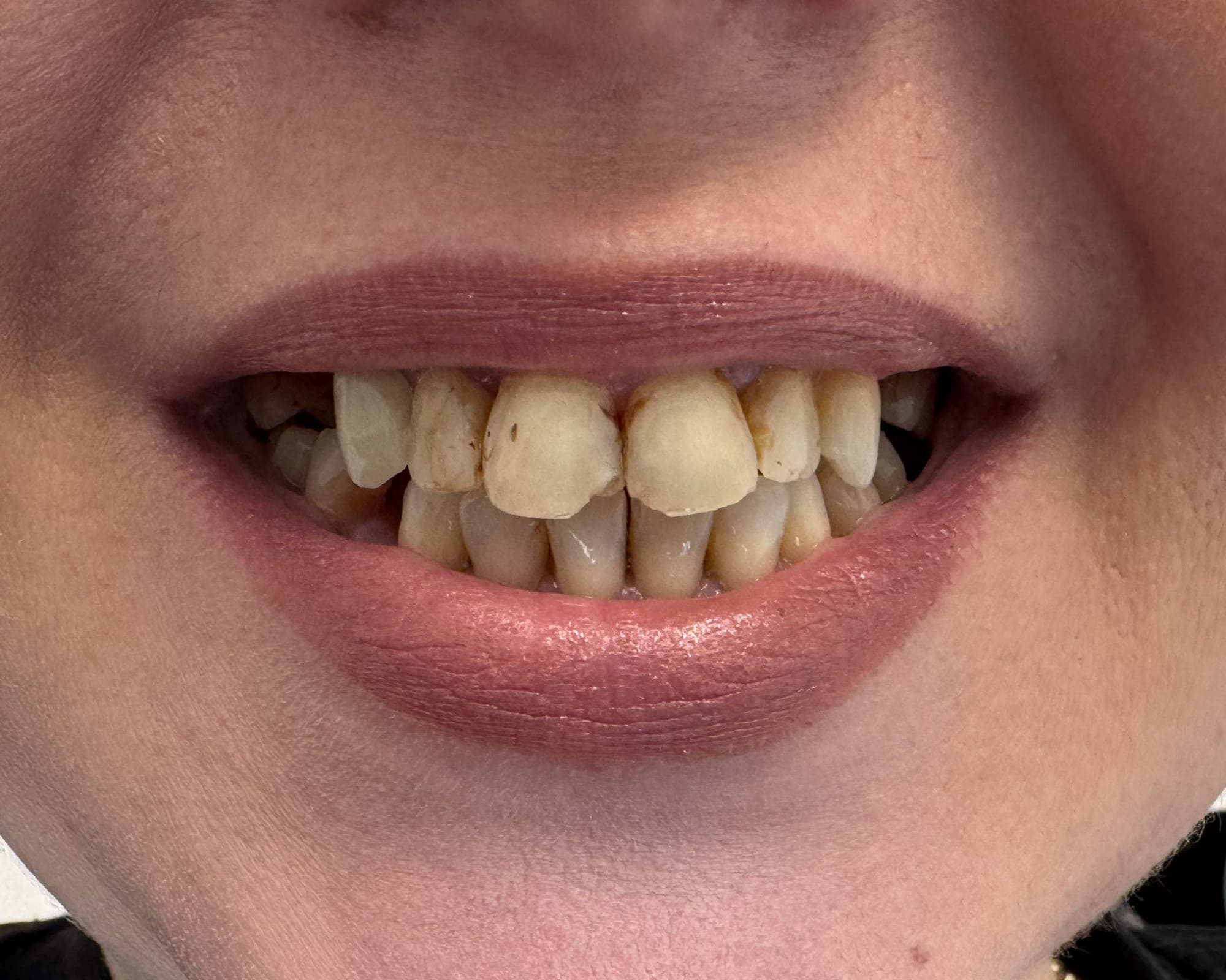 Sourire de Camille, avant