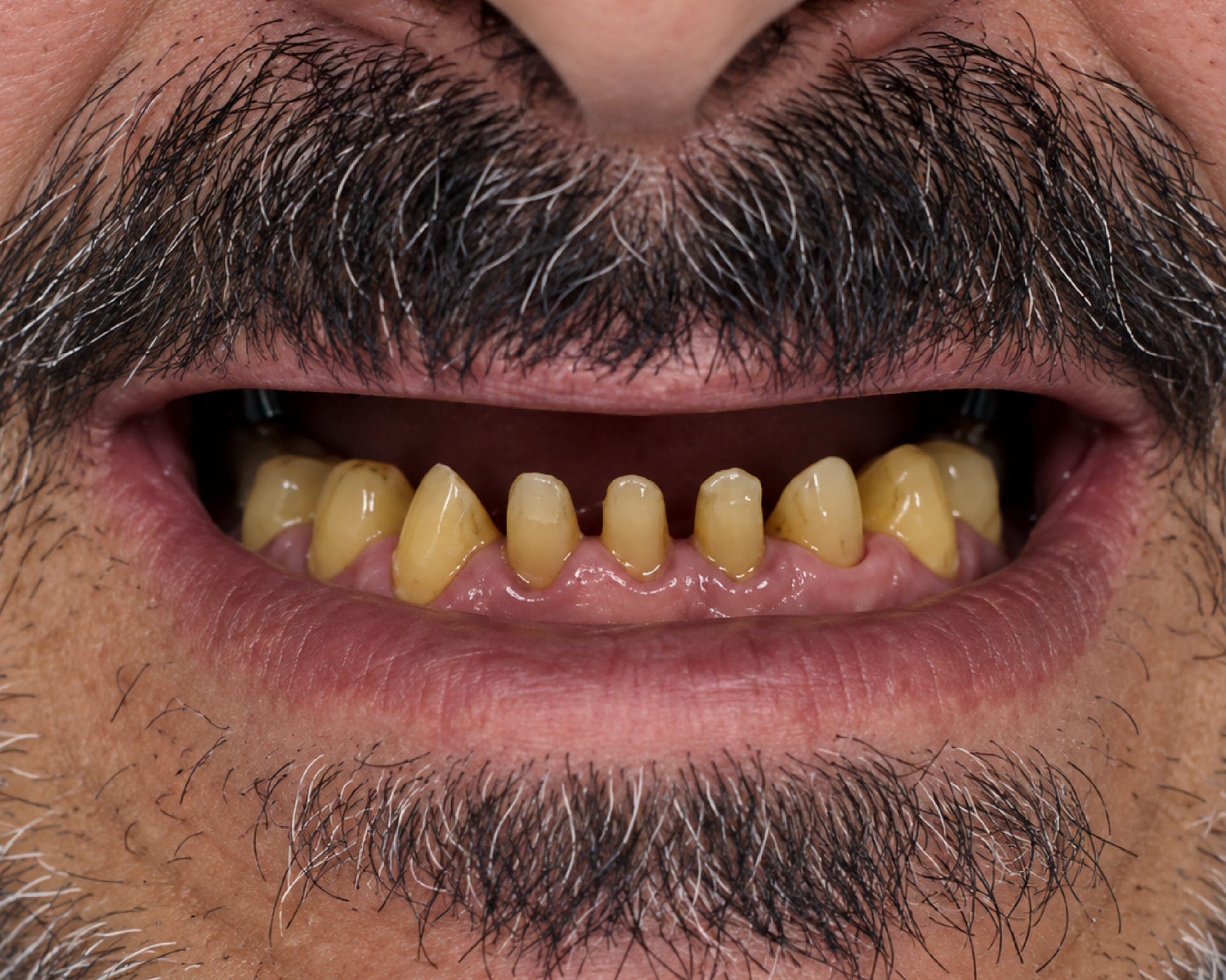 Sourire de Julien, avant