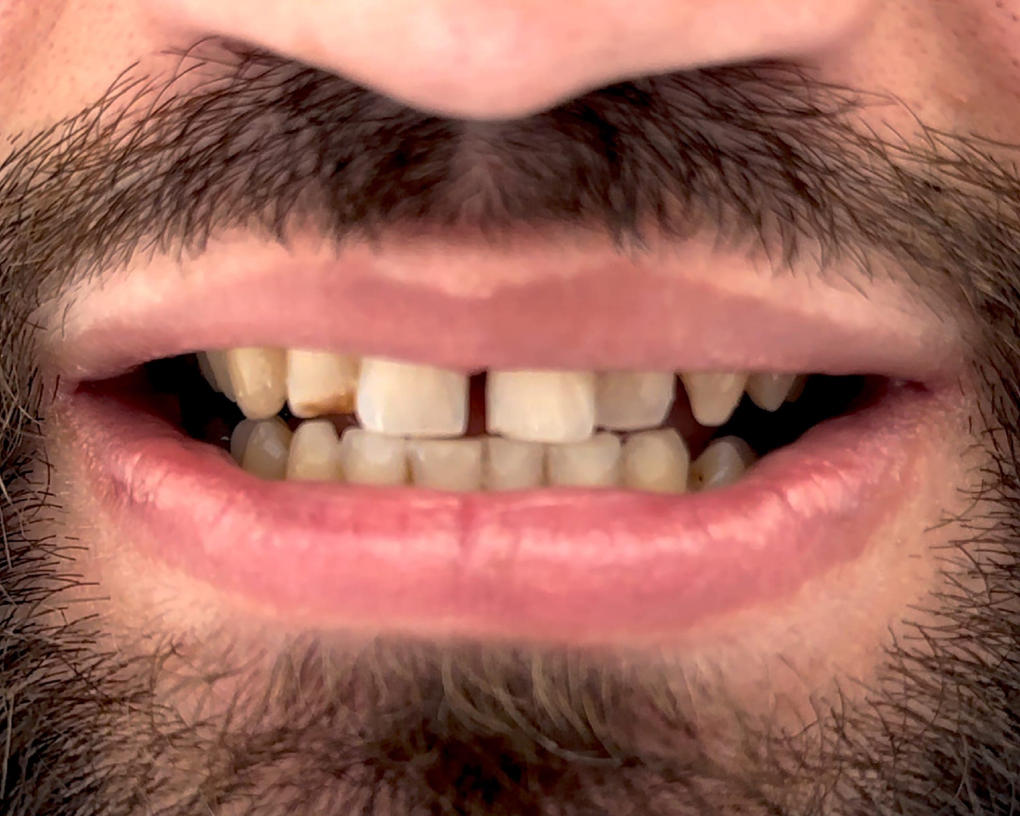 Sourire de Antoine, avant